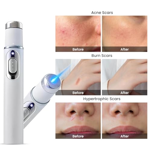 Scar & Acne Removal Laser Pen | Portable Light Therapy Beauty Device | Ideal for Wrinkles, Spots, Scars & Daily Skincare | Suitable for Home & Travel Use | Painless Skin Treatment