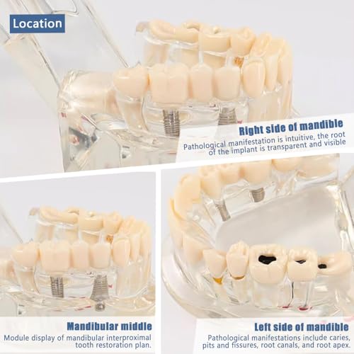 Miniatura 6 de Uadme Modelo De Demostración Dental De Dientes Transparente Desmontable