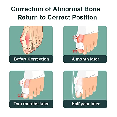 KOEMCY Alluce Valgo Correttore, Regolabile Borsiti...