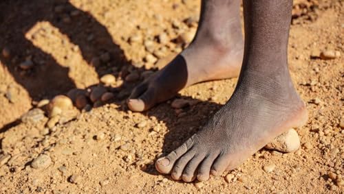 Identifying Skin Disease with AI