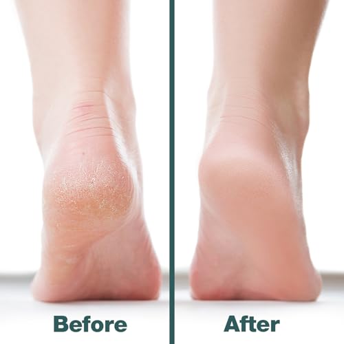 Image of Probelle Double Sided Multidirectional Nickel Foot File Callus Remover - Immediately Reduces calluses and Corns to Powder for Instant Results, Safe Tool (White)