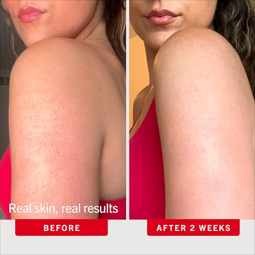 Image of First Aid Beauty KP Bump Eraser Body Scrub with 10% AHA - Dermatologist-Tested Keratosis Pilaris Exfoliator - Support for Rough Bumps, Uneven Skin Texture & Strawberry Skin - Sensitive Skin