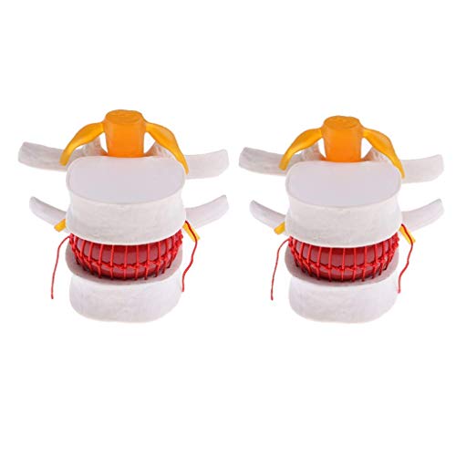 Modèle de protrusion de disque intervertébral lombaire en anatomie humaine x2