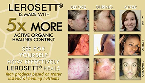 Lerosett Botanical Acne Cleanser. Gentle Foaming Gel Face Wash. 60% Calming Aloe Vera. 2% Salicylic Acid Treats Acne Prone & Oily Skin. Non-Drying. Safe For Sensitive Skin. Vegan. 6.7 Oz #TOP2