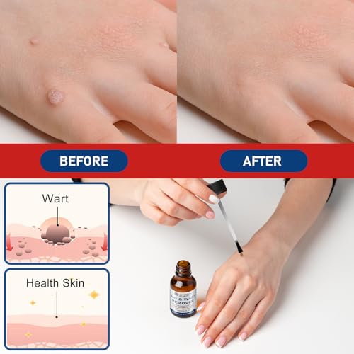 Image of inchSTAY STOKED inch Wart Remover, 15ml Liquid Wart Freeze Off - Salicylic Acid Formula with Brush Applicator-QQ1
