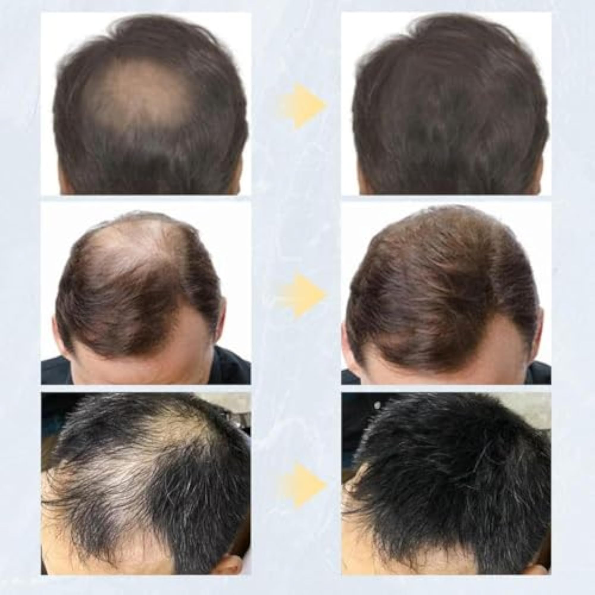 Hair Building Fiber for Thinning Hair, Dark Brown