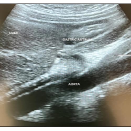 Safe Surgery for Kids: How a Simple Ultrasound Is Changing the Game