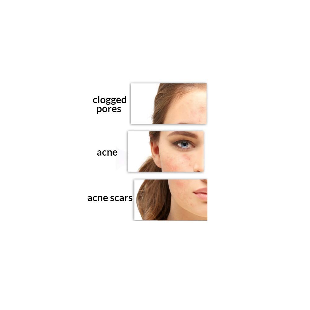 Salicylic Acid 10 Peel Perfect for beginners Light Strength