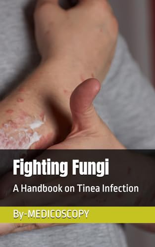 Fighting Fungi: A Handbook on Tinea Infection