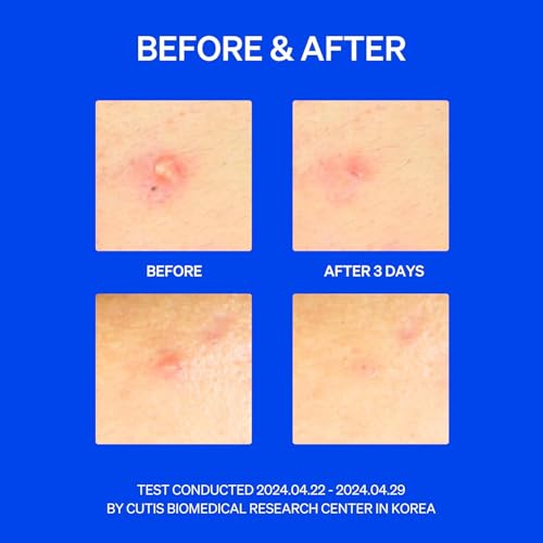 Right Away Thincognito Invisible Spot Patch - Absorbing Hydrocolloid Pimple Patch for Face, Blemishes, Zits, Acne, Breakouts Spot Treatment for Skin Care, 2 Sizes (42 Count Pack of 2)