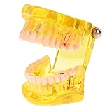 Dental Typodont Modell, Oral Brücke Implantat Modell, Für Zähne Brücke Krone Lehren Studium