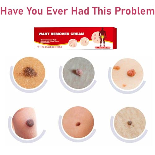Image of Wart Cream Fast Acting Gel Fast-Acting， Wart Remover Wart Remover Cream for Face, Body and Hands