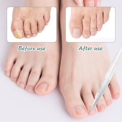 4 Stück Nail Care Pen Nagelpflegestift Gepflegte Fingernägel Fußnägel Nail Repair Pen Nagel Behandlungs Stift mit Teebaumöl Aloe Vera