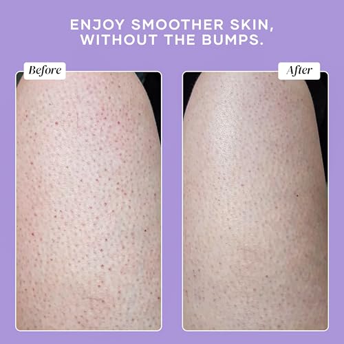 DERMAdoctor KP Bump Eraser Body Scrub with 10% AHAs + PHAs for Keratosis Pilaris, Dry, Rough, and Bumpy Skin, Dermatologist Formulated Exfoliating Body Scrub with Glycolic and Lactic acids - 16 Fl oz