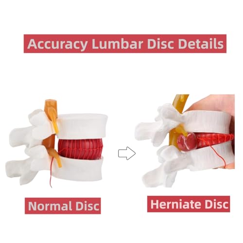 Image of Herniated Disc Spine Model, 1.5X Life Size Lumbar Spine Anatomy Model for Teaching, Chiropractic Demonstration, Medical Learning and Patient Education (1pc Spine and Disc Model)