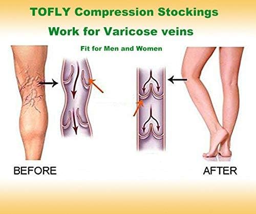 TOFLY® 30-40mmHg Medical Graduated Compression Socks for Men & Women, Open Toe Knee High Compression Socks,Firm Support for Circulation Recovery,Shin Splints,Varicose Veins,Edema,Nursing, Beige L - Image 6