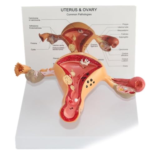 Modèle pathologique utérus ovarien pédagogique pour cours - 6