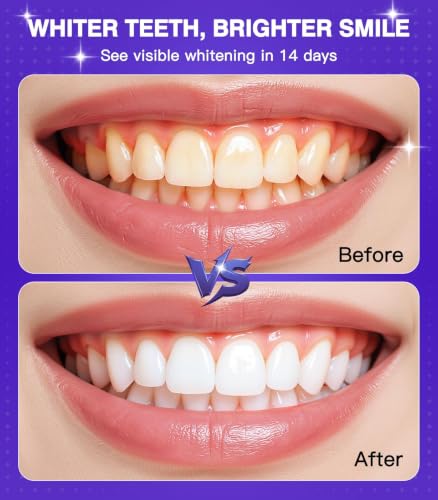 Purple Teeth Whitening Strips - image 7