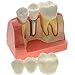 AZDENT Dental Model Implant Analysis Crown Bridge Demonstration Teeth Model for Education