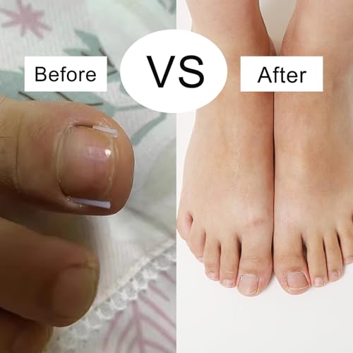 Set zur Korrektur eingewachsener Zehennägel, 62 Stück Schmerzfreie Zehennagelglättungsstreifen mit Zehennagelheber und Nagelklipper, einfaches Werkzeugse