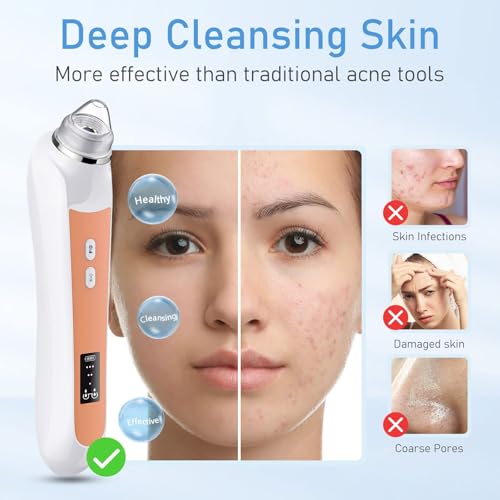 Image of Facial Pore Blackhead Remover Vacuum