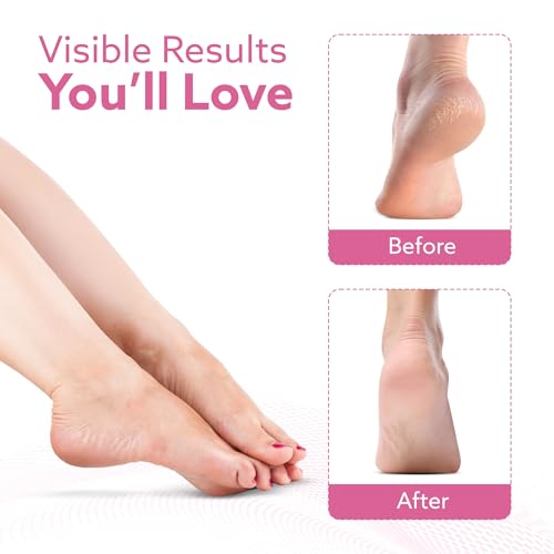 Image of AGARO Callus Remover Replaceable Heads, 2 Pcs, Callus & Dead Skin Removal Filer, Pedicure at Home