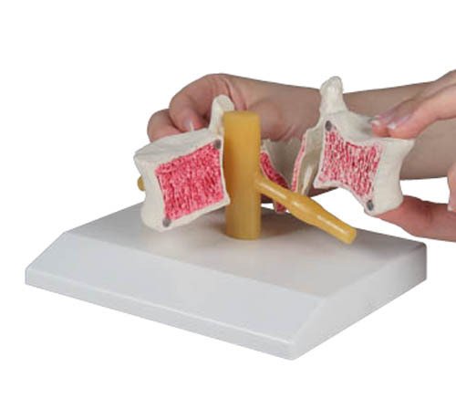 Osteoporosis vertebrae, 2X Enlarged