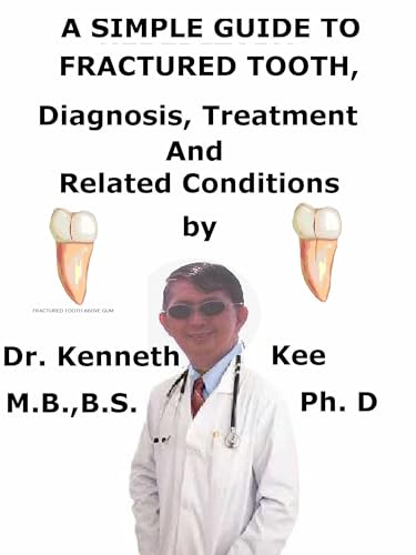 A Simple Guide To Fractured Tooth, Diagnosis, Treatment And Related Conditions