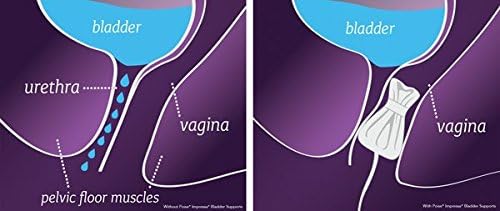Poise Impressa Incontinence Bladder Supports for Bladder Control, Size 3, 10 Count
