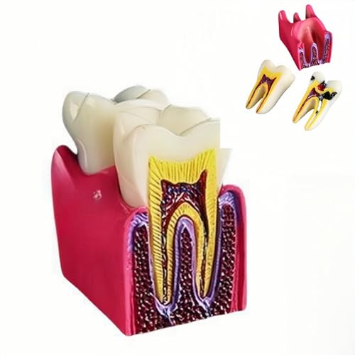 6 Times Dental Caries Model Teaching Typodont Tool for Dentists, Patients, Teachers and Students Studying and Researching (Teeth Removal)