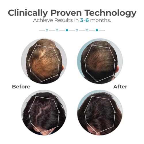 Capillus Plus Laser Therapy Cap for Hair Regrowth, Red Light Hair Therapy with 202 Medical Grade Red Light Lasers for Laser Hair Growth, Red Light Hair Growth Hat At Home