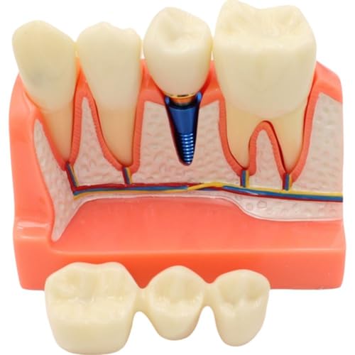 Modèle d'implant dentaire pour résoudre les erreurs d'analyse de pont - 2