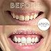 MOON Teeth Whitening Kit, Platinum Teeth Whitener LED Device, 28 Dissolving White Strips, Yellow, Blue & Red Light Whitening Tray for Gum Health & Fresh Breath, Whitens Up to 18 Shades (4 Piece Kit)