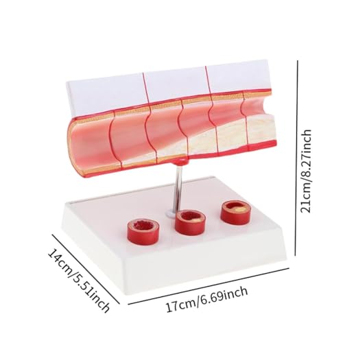 Modèle vasculaire de thrombose AMITD numéroté pour cours médicaux - 6