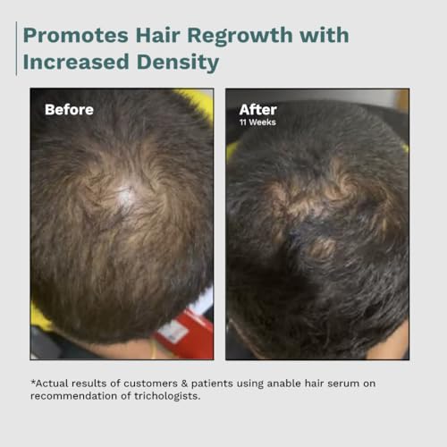 Image of Anable Anti Hair Fall & Hair Regrowth Serum | 3% Redensyl + 3% Procapil + 2% Anagain | Reduces Hair Thinning, Strengthens Hair Roots & Promotes New Growth | For Men & Women | Safe, Non-Greasy & Dermatologist Tested | 50ml