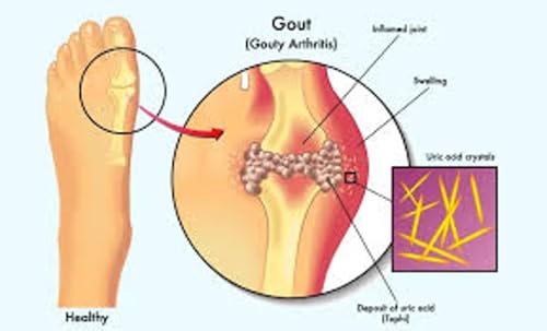 What is Uric Acid?: How to clear Uric Acid level in your Body (English Edition)