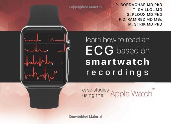 Reading Smartwatch Learn how to read an ECG based on smartwatch recordings: clinical cases ...