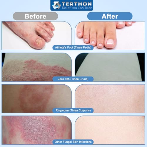Herbal Antifungal Cream: Treatment for Ringworm, Jock Itch, Athlete's Foot & Fungal Skin Infections – Natural, Fast-Acting Formula for Adults and Kids, 20g (1 Pack) - Image 2
