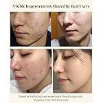 Centella Asiatica Serum Korean - Redness Corrector for Face - 38% Cica Leaf Water and Madecassoside - Ph Balanced - Barrier Support - Lightweight Calming - Rosacea Skincare Serum - Centella Ampoule - Image 3