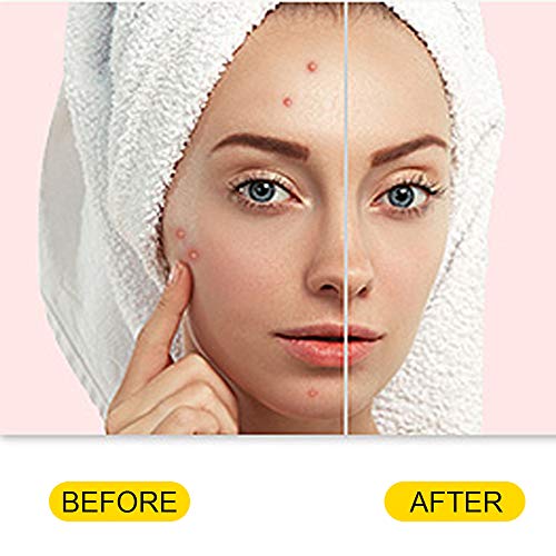 Blackhead Remover Tool, Aooeou Professional Pimple Popper Tool Kit - Easy Removal For Blemish, Whitehead Popping, Zit Removing For Risk Free Nose Face, Anti-Slip Coating Handle (B-Silver) #TOP6