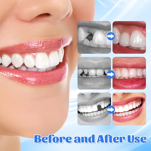 Provisorische Zahnfüllung Reparatur-Kit, Zahnersatz Selber Machen, 30ML ZahnfüLlung Zahnzement, Zahnreparatur Perlen, Zahnreparatur-Kit für Reparieren Fehlender Gebrochener und Großer Zahnlücken