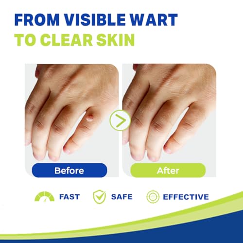 Image of Wart Acid Remover 5ml | Fast Acting Wart Removal Solution with Monochloroacetic Acid (MCA) | Precise Applicator for Common Warts on Hands and Feet | Liquid Form | 4 Years+