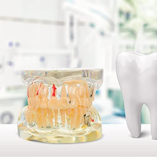 DOITOOL Tandheelkundig implantaat Tanden Model Transparante Volwassen Pathologieën Implantaat Demonstratie Tanden… - Image 5