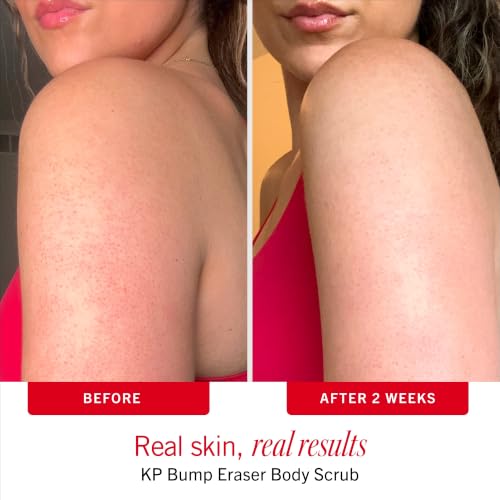 Image of First Aid Beauty KP Bump Eraser Body Scrub with 10% AHA - Dermatologist-Tested Keratosis Pilaris Exfoliator - Support for Rough Bumps, Uneven Skin Texture & Strawberry Skin - Sensitive Skin