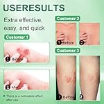 Soothing Relief Cream for Skin Irritation | Fast-Acting Formula for Itch Relief & Skin Comfort | 20g(2 Pieces) - Image 2