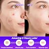 Cat Pimple Patches,Cute Pimple Patches,Acne Patches for Face, Cute Stickers,Salicylic Acid & Tea Tree, 120 Hydrocolloid Dots in 20 Colors for Face,Cute Cat Pimple Stickers