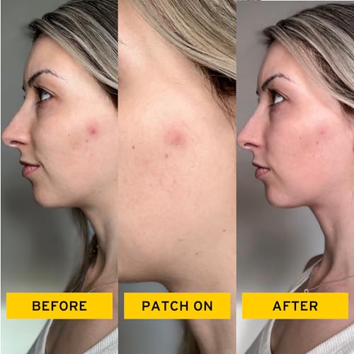 No BS Healing Acne Patches - Hydrocolloid, Acne Spot and Pimple Treatment to Prevent Acne Scars. Invisible On All Skin Tones (1 BOX of 72ct)