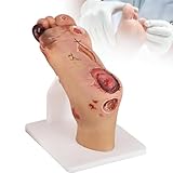 Diabetes-Fuß-Modell, 1:1 Pathologischer Vergleich (Mild & Schwer), Anatomiemodell für Krankenpflegeausbildung & Podiatrie, Simulation von Diabetischem Fußsyndrom & Geschwüren,Severe