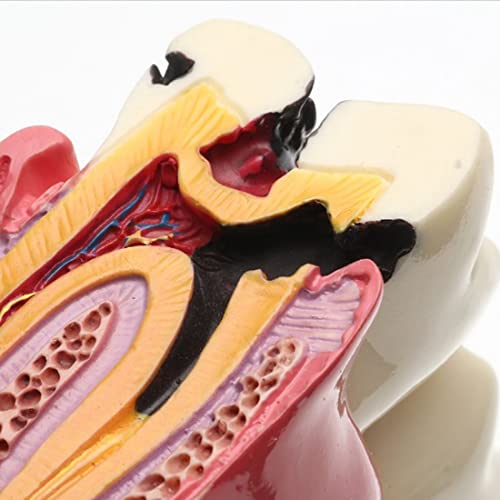 Dental Caries Tooth Model, YOUYA DENTAL 6 Times Caries Tooth Model Dental Anatomy Education Tooth Model Decay Teeth Comparative Study Model Teaching Typodont Model for Dentists Student Education