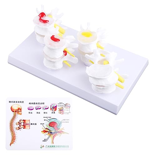 1 Set Human Lumbar Lesion Spine Statue Display Model Medical Teaching Learning F